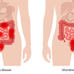 crohn's disease