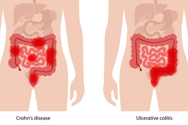 crohn's disease