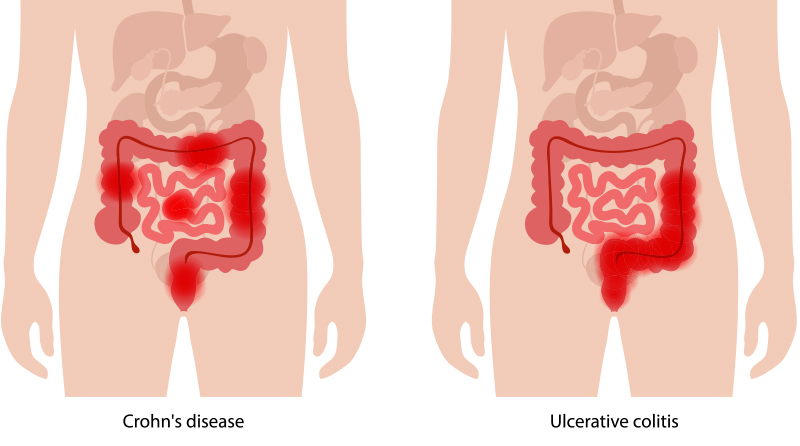 crohn's disease